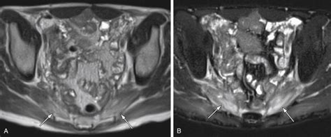 Magnetic Resonance Imaging Of The Female Pelvis Technique Anatomy And Pitfalls Radiology Key