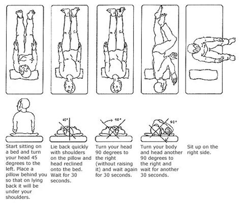 What's to blame for your dizziness? Image result for modified epley maneuver | Epley maneuver ...