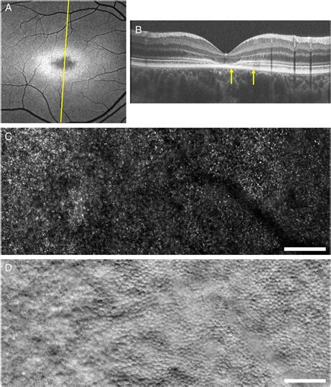 Stargardt Disease Clinical Features Molecular Genetics Animal Models