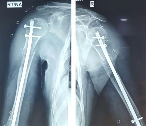 Healing Of Pathological Fracture In A Case Of Multiple Myeloma Bmj