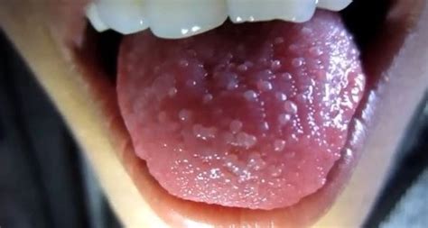 Inflamed Swollen Enlarged Taste Bud Causes Remedies Treatment