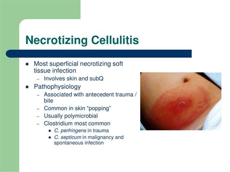 Ppt Soft Tissue Infections Powerpoint Presentation Id760835
