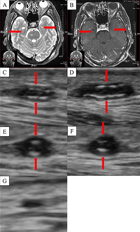 Figuremagnetic Resonance Imaging Of The Temporal Arteries A Fat