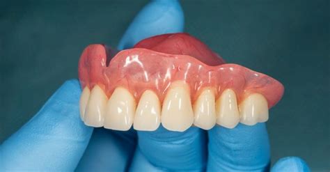The Different Types Of Dentures Available Today Olds Denture