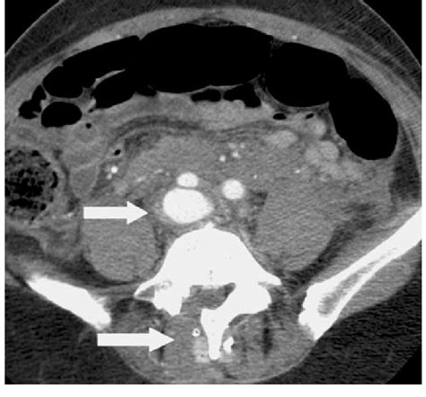 Ct Scan At The Level Of L5 Showing Active Contrast Extravasation Behind