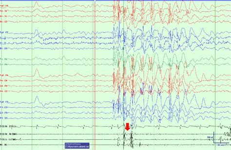 Figure 1 From Epilepsy With Myoclonicatonic Seizures Doose Syndrome