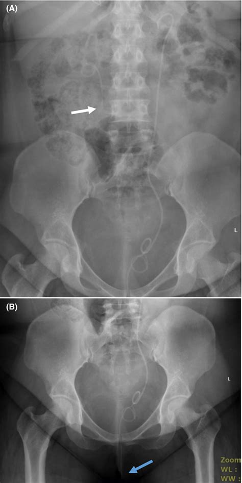 Imaging Of The Second Case A Plain X‐ray Kub Showing The Site Of
