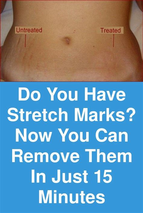 Do You Have Stretch Marks Now You Can Remove Them In Just Minutes