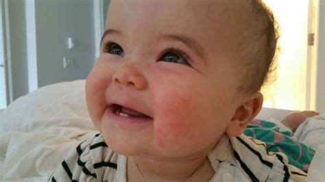 Rashes that develop from eating foods that cause allergic reactions can cause intense itching. Food allergy?? Skin rush on baby's face - September 2015 ...