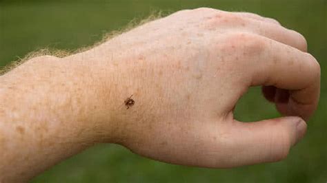 Tick Bites Itching Archives Home Remedies And Natural Treatments