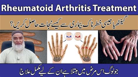 Rheumatoid Arthritis Treatment In Urdu Hindi Ganthiya Ka Ilaj Or
