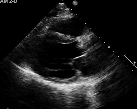 Cureus An Unusual Case Of Severe Aortic Stenosis And Triple Vessel