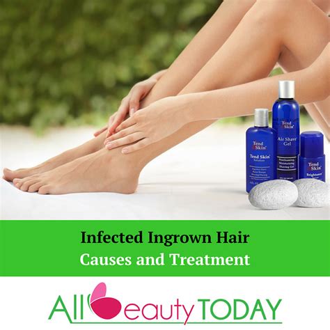 Infected Ingrown Hair Causes And Treatment All Beauty Today