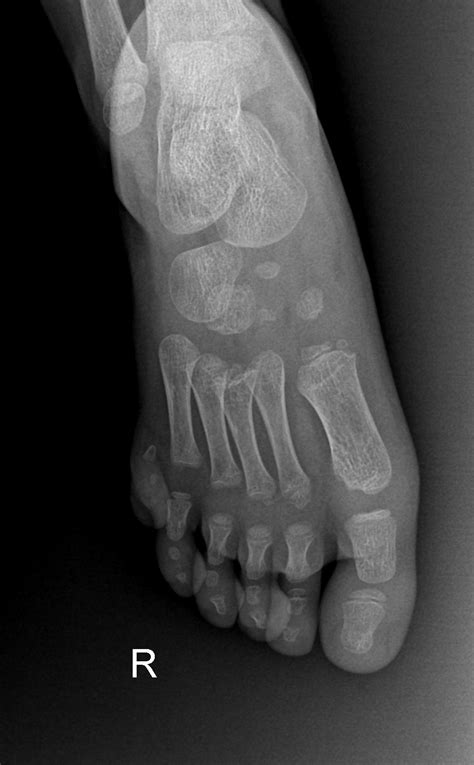 Postaxial Polydactyly Image Radiopaedia Org