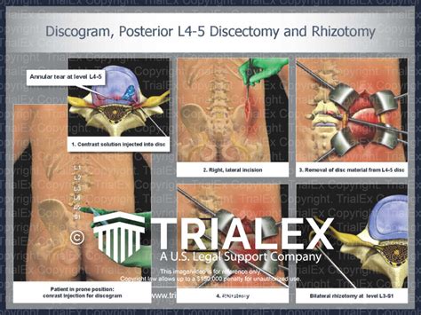 Discogram Posterior L4 L5 Discectomy And Rhizotomy Trialexhibits Inc