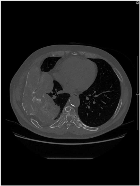 An Axial Ct Image Shows The Extra Osseous Tumor With Calcification And