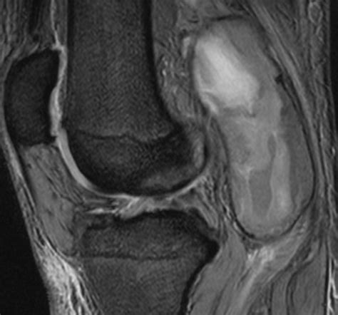 Incidental Finding Of A Giant Popliteal Aneurysm On Mri Of The Knee