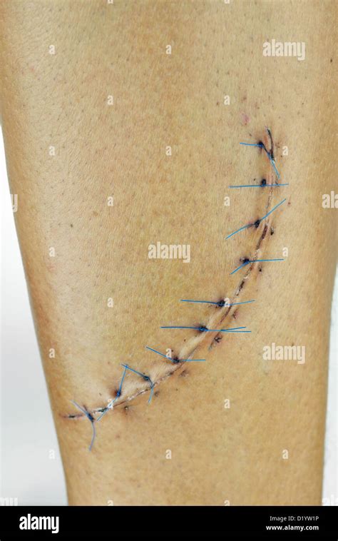 Leg Stitches Hi Res Stock Photography And Images Alamy