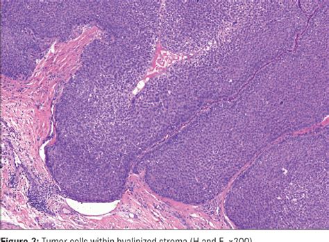 Malignant Nodular Hidradenoma Of The Eyelid A Rare Sweat Gland Tumor