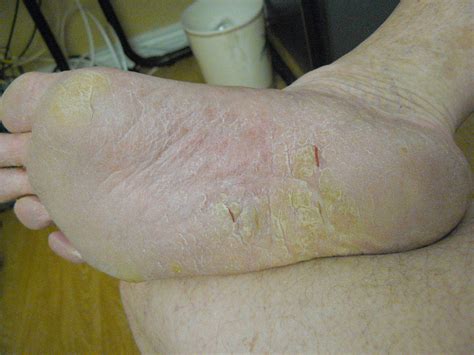 I'm thinking maybe fungal infection? Peeling and cracking skin on bottom of both feet
