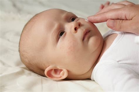 Eczema In Babies Hope Dermatology