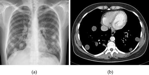 Chest Radiograph Multiple Hydatid Cysts Located In Both Lungs Cysts