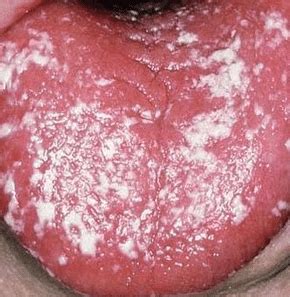 Hiv/aids, leukoplakia (when cells in the mouth grow excessively) and geographic tongue (reddish spots on the tongue with a white boarder) are. White Spots on Tongue, Bumps, Patches, Painful, Sore ...