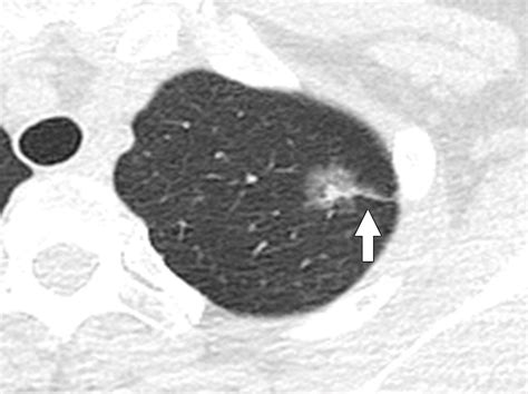 Pleural Tags On Ct Scans To Predict Visceral Pleural Invasion Of Non