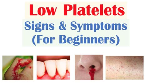 What Deficiency Causes Low Platelets The 8 Latest Answer Ar