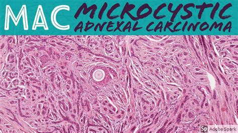 Microcystic Adnexal Carcinoma Mac 5 Minute Pathology Pearls Youtube
