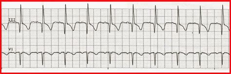 Float Nurse Ekg Rhythm Strip Quiz 181