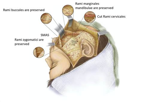 Neurectomy Myotomy And Myectomy Fazialis
