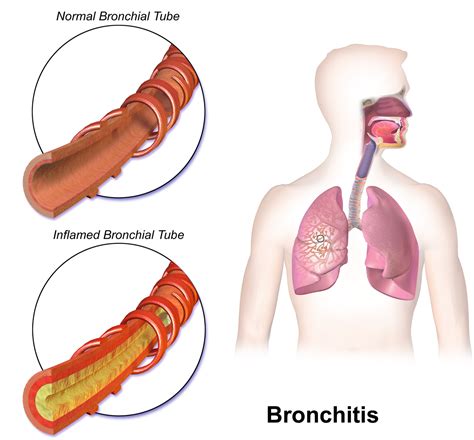 Your diagnostic tests and medical history can help. Chronic Bronchitis: New Insights Could Lead To First ...