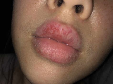 How To Heal A Rash On Your Lips | Lipstutorial.org
