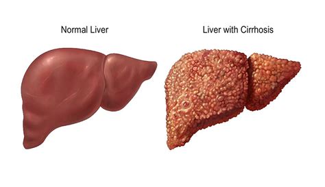 Liver Cirrhosis The Healthy Liver How To Clean Your Liver