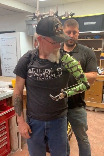 Above The Elbow Prosthetic Arms In Las Vegas And Henderson Evolve