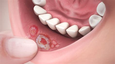 The Human Body What Is A Mouth Ulcer How It Works