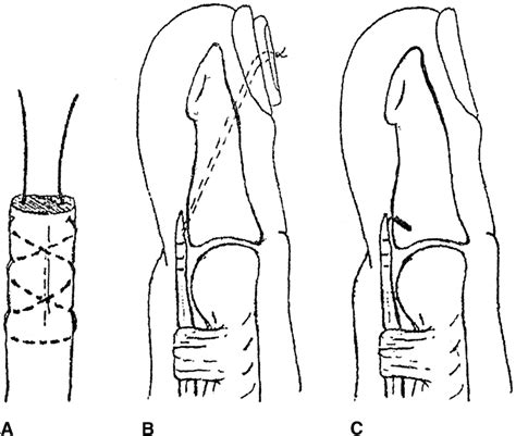 A Bunnell Technique Of Suture Insertion Into The Tendon B Pullout Download Scientific