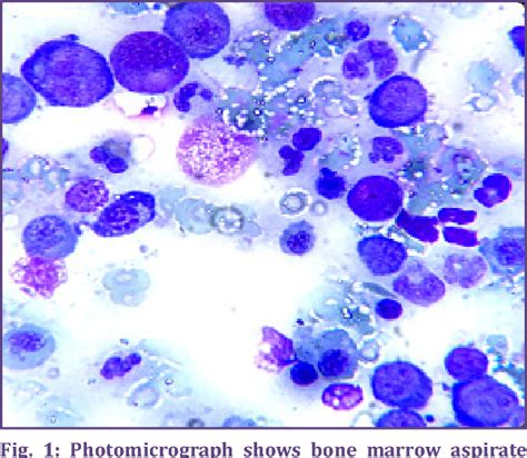 Figure 1 From Diagnostic Approach Of New Onset Pancytopenia Study From