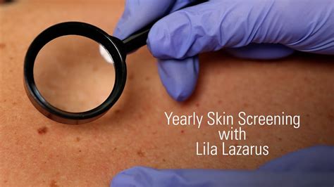 Annual Skin Cancer Screening What To Expect Youtube