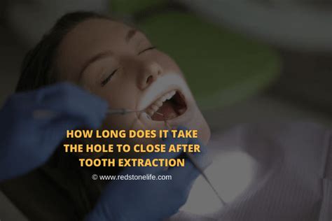How Long Does It Take The Hole To Close After Tooth Extraction Tooth