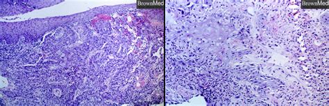 Squamous Cell Carcinoma Of Larynx Pathology Residency And Fellowship