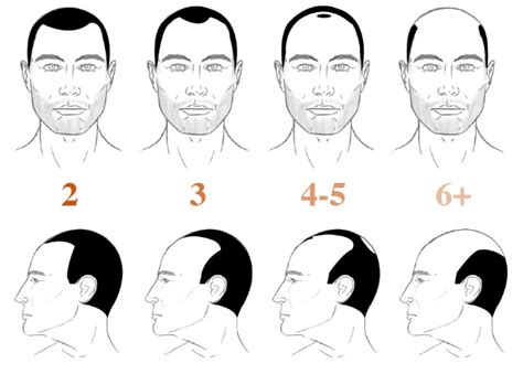 Norwood Hamilton Scale For Hair Loss Measuring Male Pattern Baldness