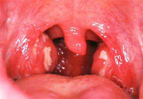 Tonsillitis Photograph By Dr P Marazziscience Photo Library