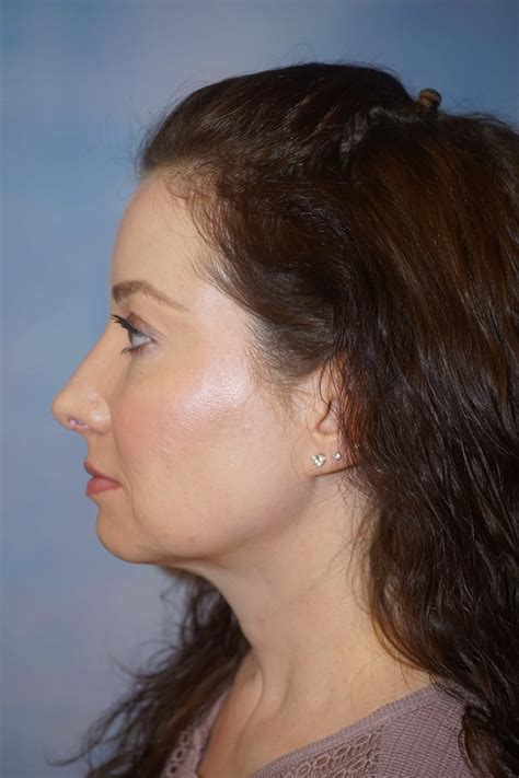 Female Rhinoplasty Red Bank Nj Riverside Nasal And Sinus Center