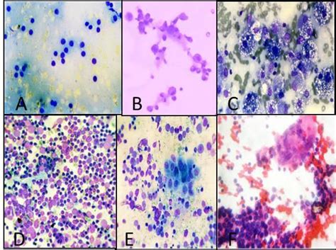 Microphotographs Of Fnnac Smears From Thyroid Lesions Acolloid