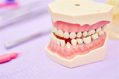 Malocclusione Dentale Sintomi E Classificazione Wedental Care