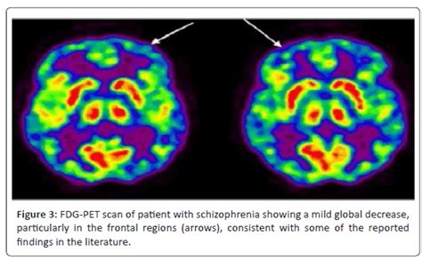 Schizophrenia Brain Scan Vs Normal Mri Scan Detects Signs Of Schizophrenia Brain Imaging