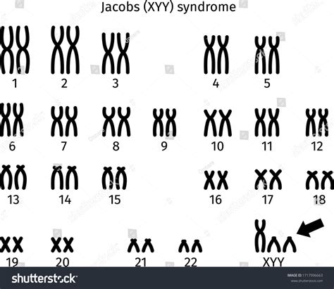 Scheme Jacobs Xyy Syndrome Karyotype Human Stock Vector Royalty Free 1717996663 Shutterstock