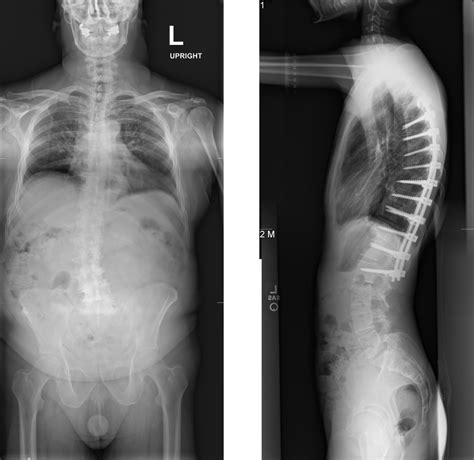 Scoliosis Pathology Radiology U Of U School Of Medicine